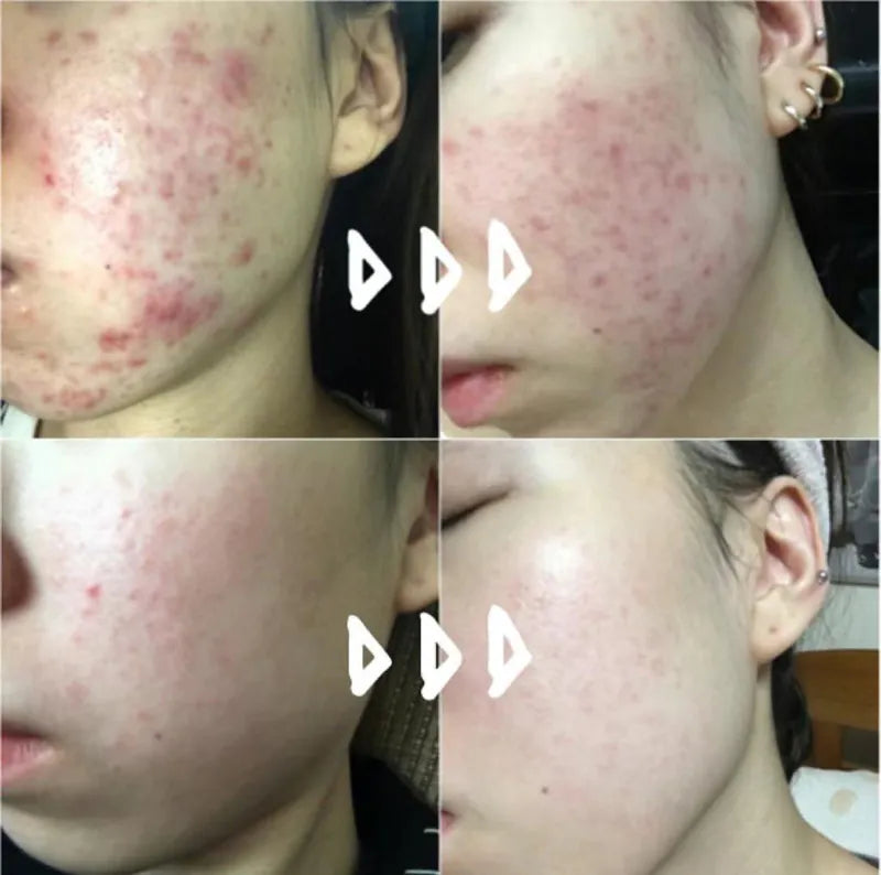韓國製:藥房熱賣🔥Kwangdong Q Acne Plus Cream 速效祛痘膏(B527)