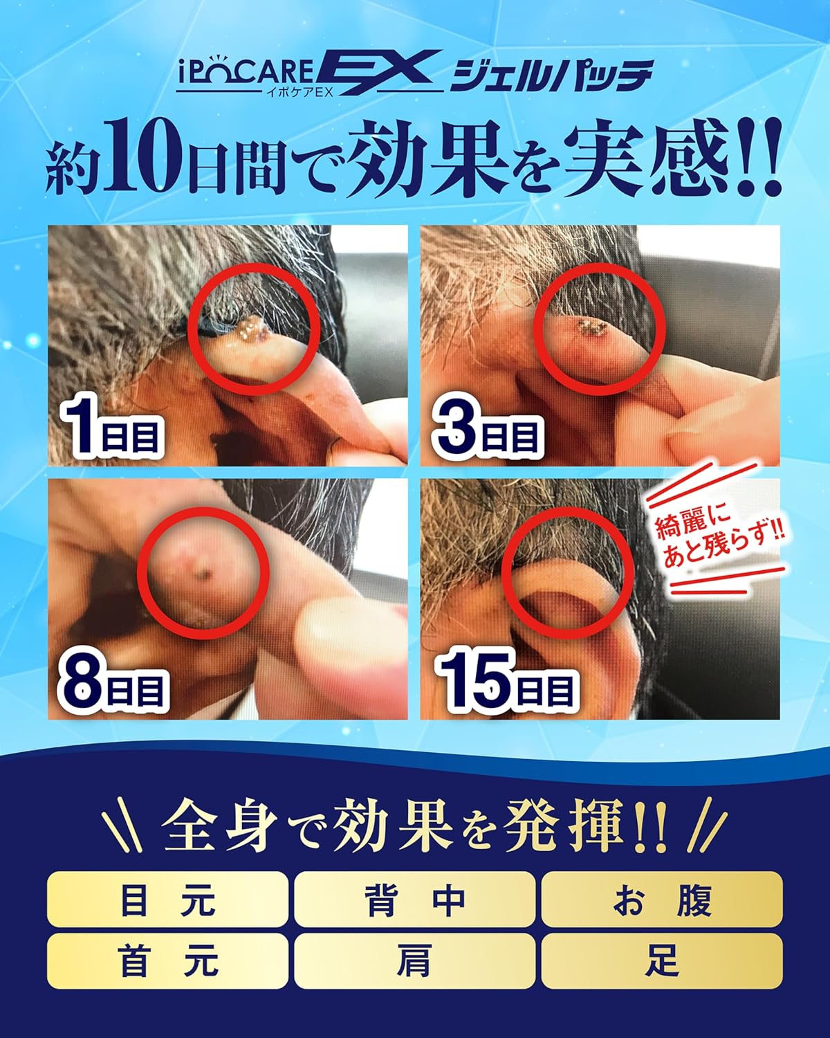 日本製:IPOCARE EX 除疣專用美容啫喱 25g (B569)