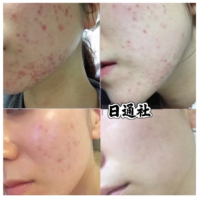 韓國製:韓國熱賣🏥 Noscarna 去疤去印膏 20g 大支裝 (B525)