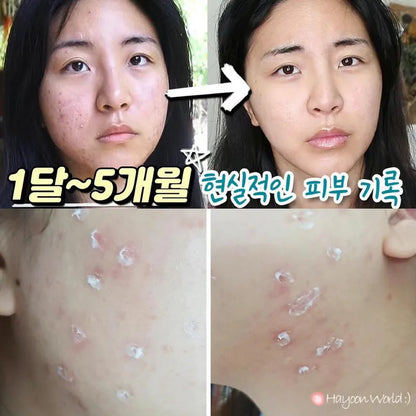 韓國製：藥房熱賣🔥Kwangdong Q Acne Plus Cream 速效祛痘膏(B527)