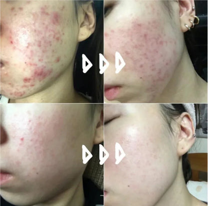 韓國製：藥房熱賣🔥Kwangdong Q Acne Plus Cream 速效祛痘膏(B527)