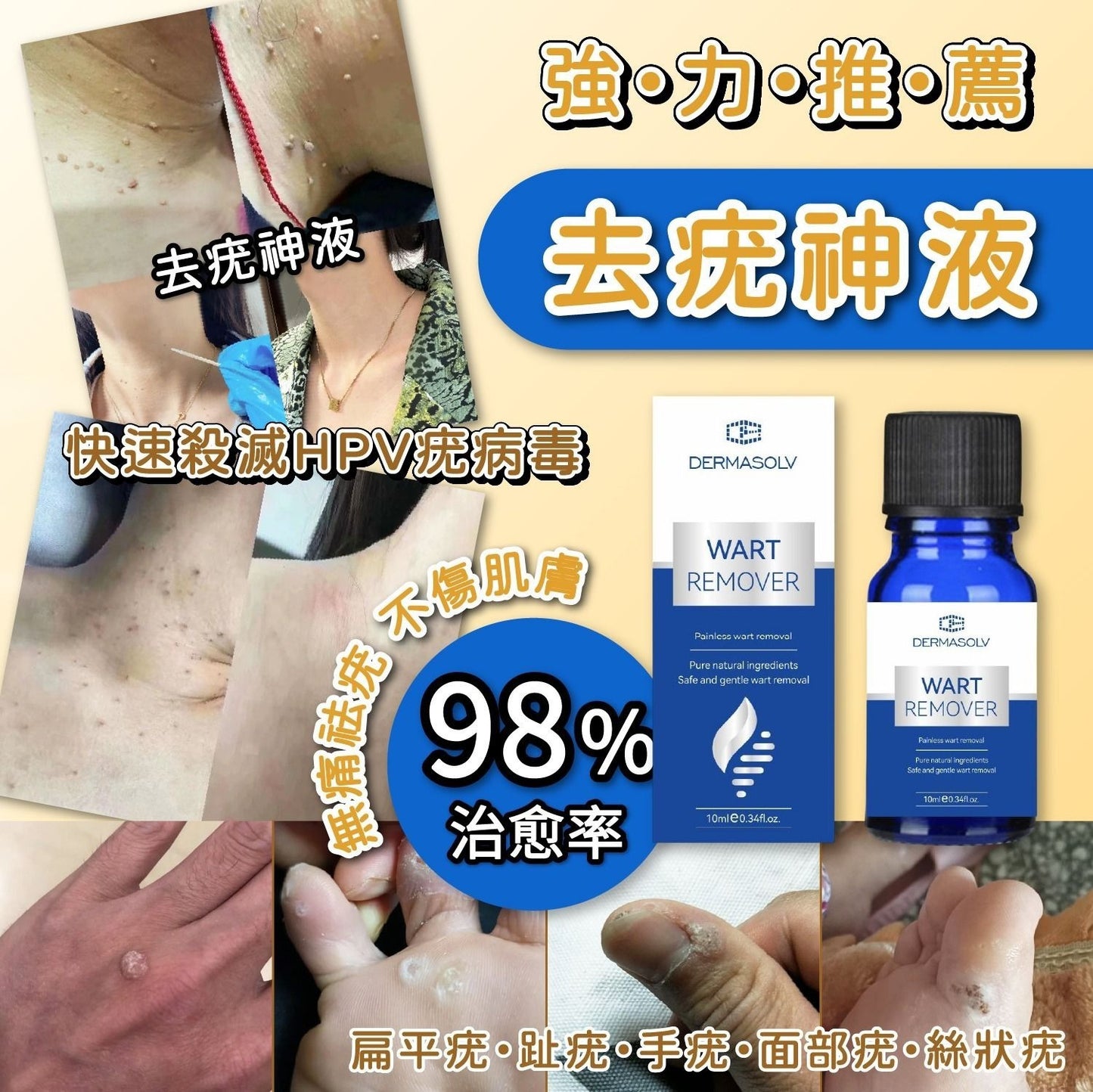 日本製：DermaSolv 強力去疣神液 10ml  (B3172)