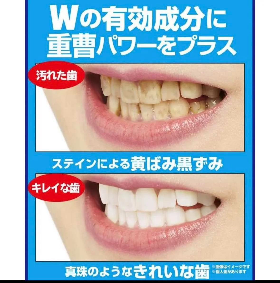 日本製：JUSO 集中藥用美白牙齒凝膠 (B3006)